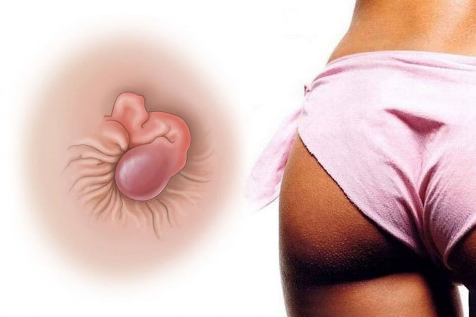 La crème naturelle guérit les hémorroïdes en un seul cours